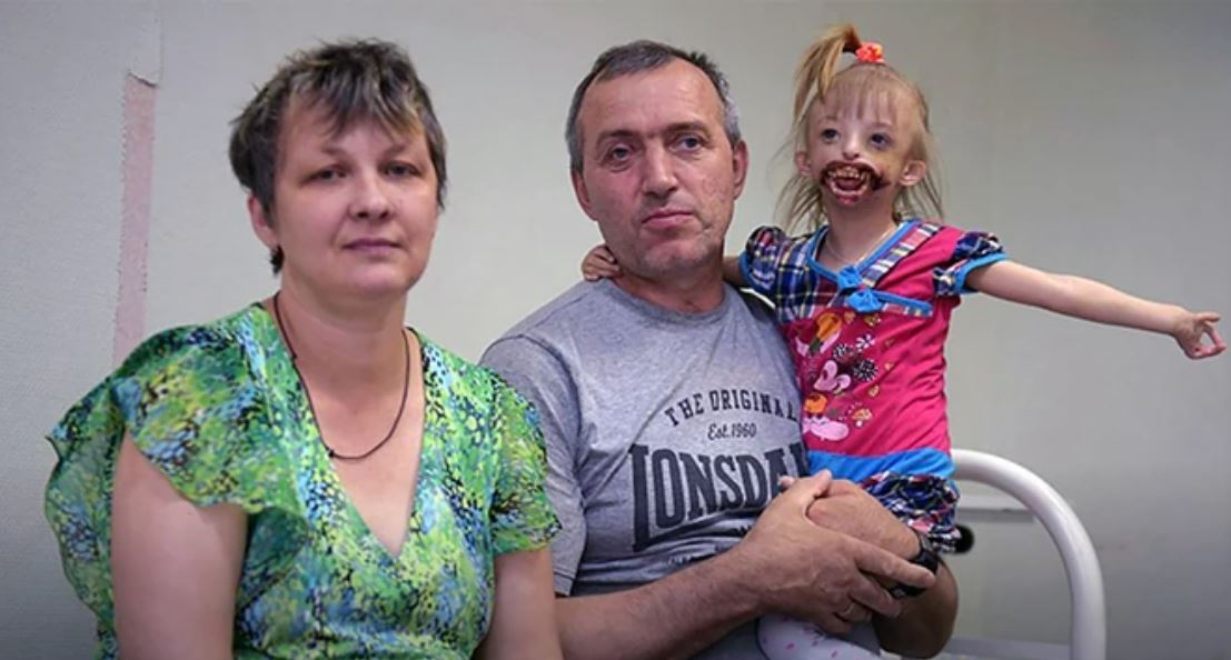 1747999264 101 Изоставена като бебе заради рядко заболяване без челюст и уста