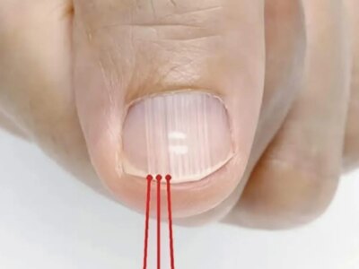 ako imate takiva linii po noktite tova e yaven priznak