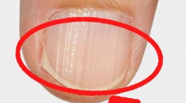 ako takiva linii se poyavyat po noktite vi sled 40 godishna vzrast tova e yasen znak che